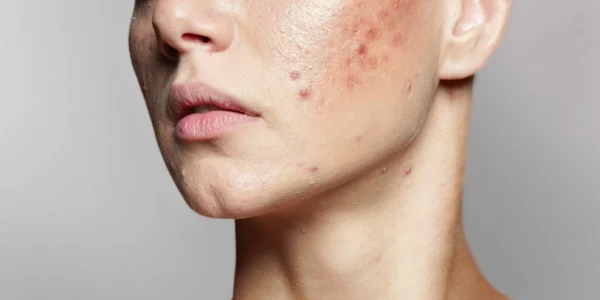 Is Combination Acne Therapy the New Beauty Standard?